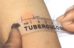 Туберкулез анализ крови у детей норма thumbnail